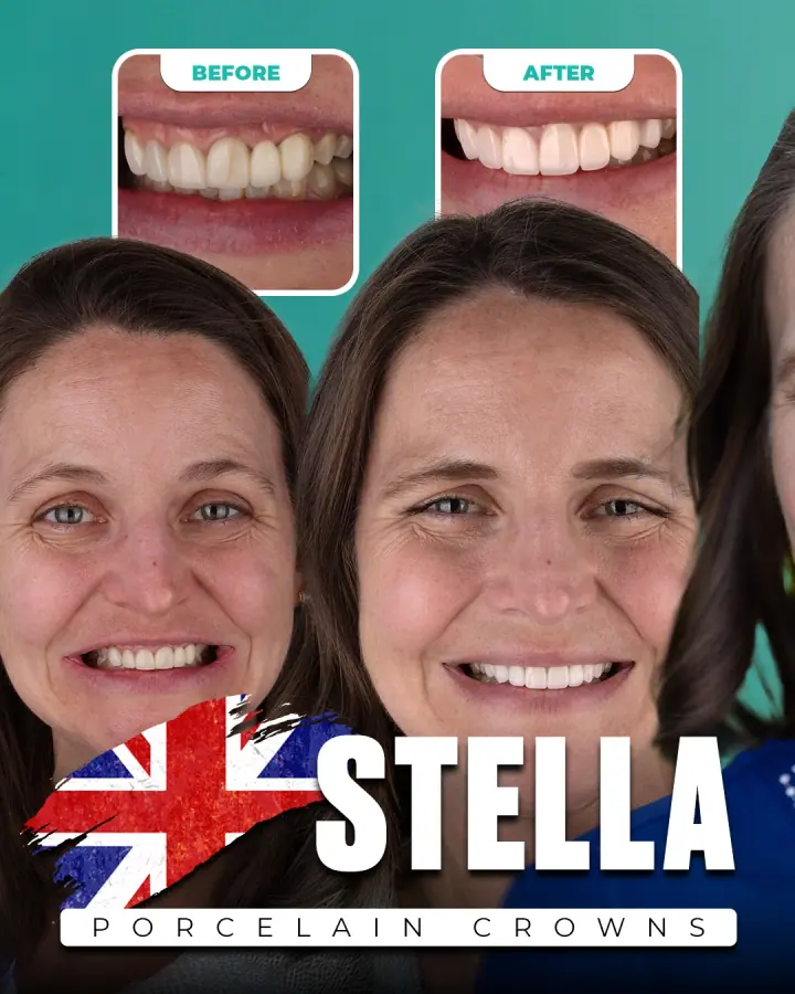 Vorher und nachher, Porzellankronen: Stella, Vereinigtes Königreich. Die Collage der Klinik zeigt oben Nahaufnahmen der Zähne vorher und nachher, darunter zwei Porträts.