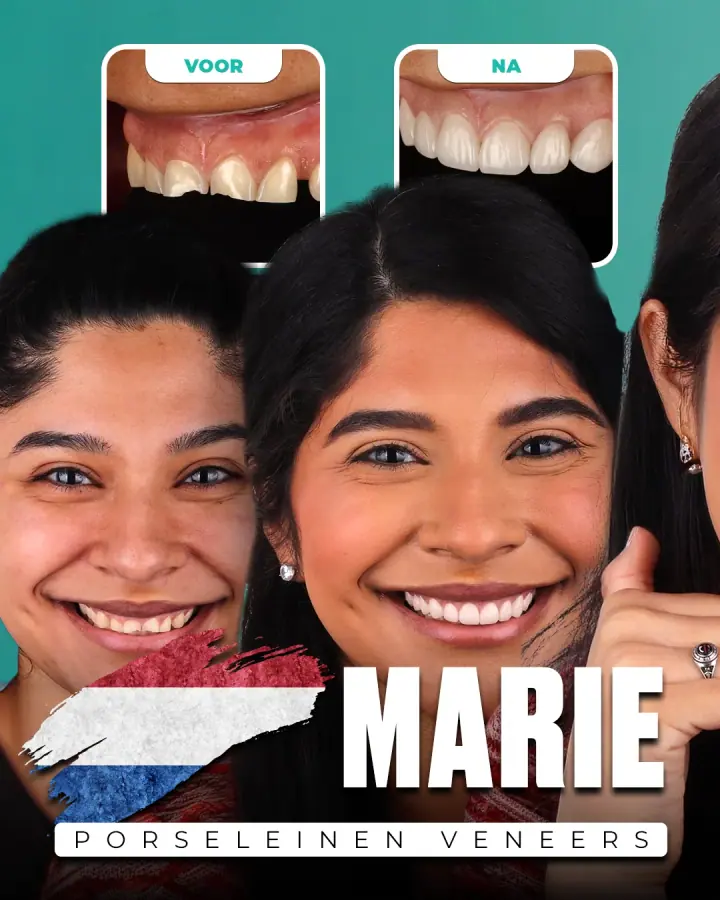 Vorher und nachher, Keramikveneers: Marie, Niederlande. Die Collage der Klinik zeigt oben Nahaufnahmen der Zähne vorher und nachher, darunter zwei Porträts.
