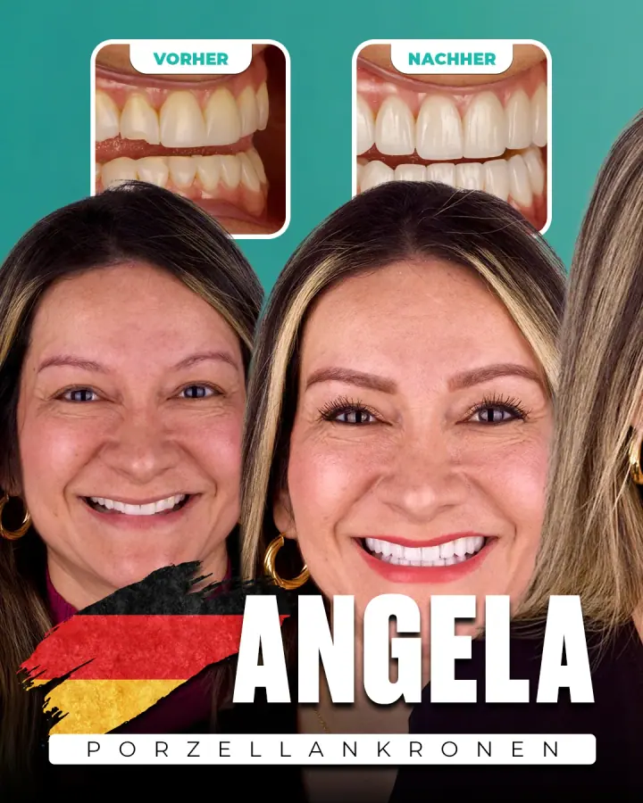 Vorher und nachher, Porzellankronen: Angela, Deutschland. Die Collage der Klinik zeigt oben Nahaufnahmen der Zähne vorher und nachher, darunter zwei Porträts.