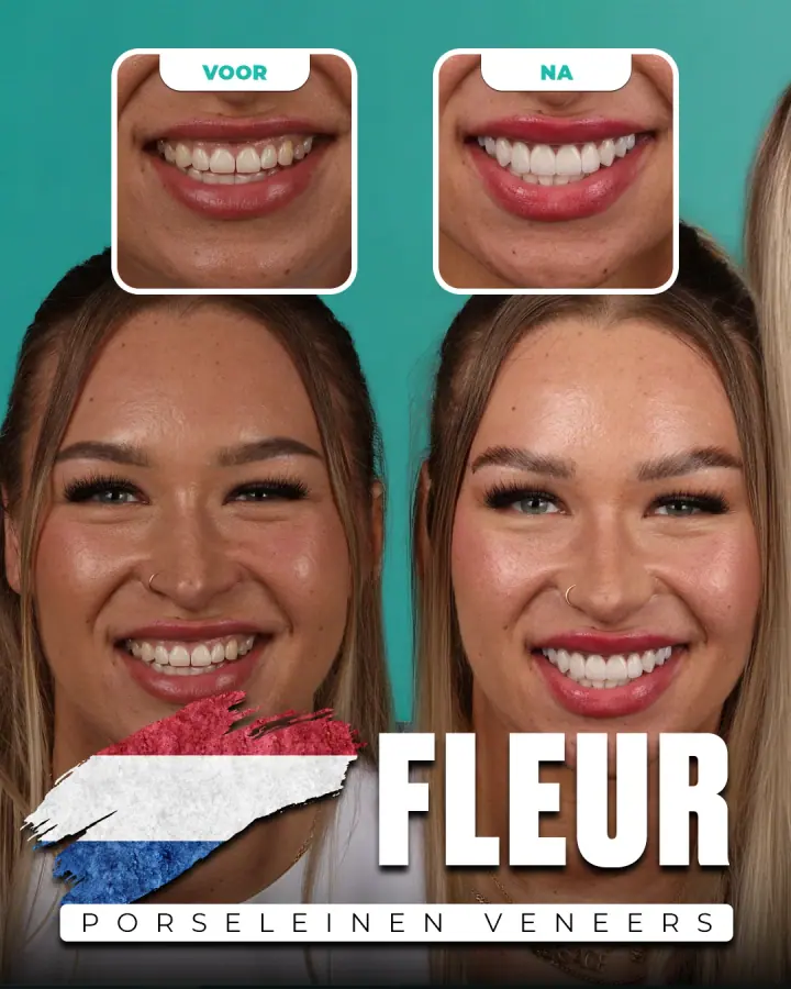 Vorher und nachher, Keramikveneers: Fleur, Niederlande. Die Collage der Klinik zeigt oben Nahaufnahmen der Zähne vorher und nachher, darunter zwei Porträts.