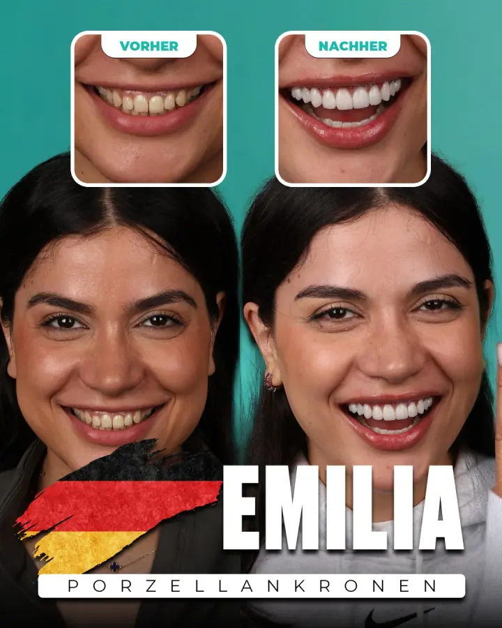 Vorher und nachher, Porzellankronen: Emilia, Deutschland. Die Collage der Klinik zeigt oben Nahaufnahmen der Zähne vorher und nachher, darunter zwei Porträts.