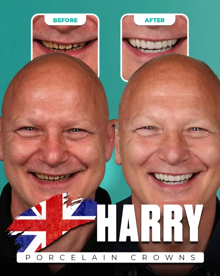 Vorher und nachher, Porzellankronen: Harry, Vereinigtes Königreich. Die Collage der Klinik zeigt oben Nahaufnahmen der Zähne vorher und nachher, darunter zwei Porträts.