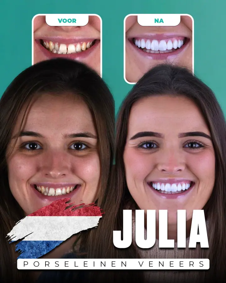 Vorher und nachher, Keramikveneers: Julia, Niederlande. Die Collage der Klinik zeigt oben Nahaufnahmen der Zähne vorher und nachher, darunter zwei Porträts.