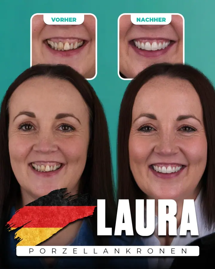 Vorher und nachher, Porzellankronen: Laura, Deutschland. Die Collage der Klinik zeigt oben Nahaufnahmen der Zähne vorher und nachher, darunter zwei Porträts.