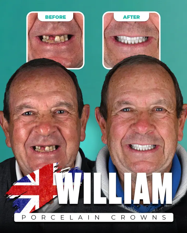 Vorher und nachher, Porzellankronen: William, Vereinigtes Königreich. Die Collage der Klinik zeigt oben Nahaufnahmen der Zähne vorher und nachher, darunter zwei Porträts.