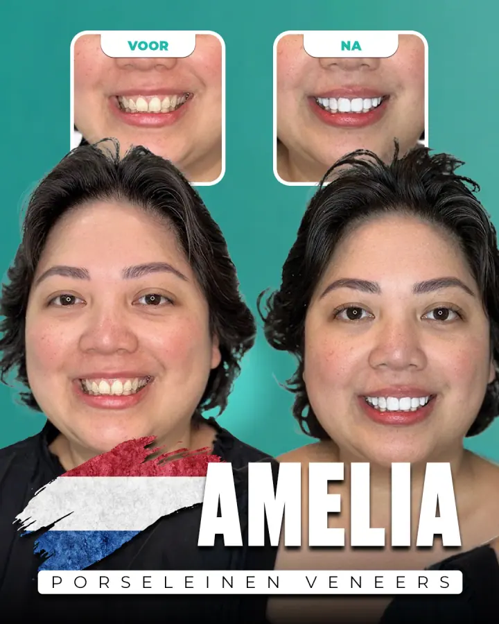 Vorher und nachher, Keramikveneers: Amelia, Niederlande. Die Collage der Klinik zeigt oben Nahaufnahmen der Zähne vorher und nachher, darunter zwei Porträts.